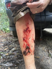 Attacked by Leeches- TMI Photos