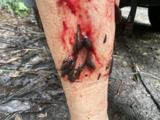Attacked by Leeches- TMI Photos