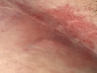 TW PICTURE - C section scar looking like this after 2 years?