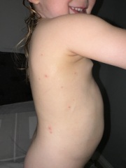 Blisters. What’s is this??? 
