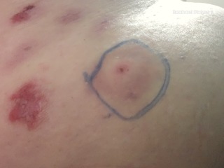 Sore and bruise explanding