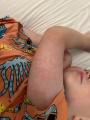 Strange rash coming and going on DS