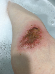 Does this graze look infected?