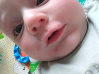 Is this dribble rash?