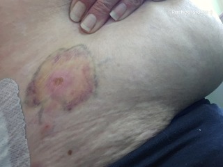 Sore and bruise explanding