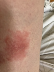 Is this a cold sore on my leg? Pic incl