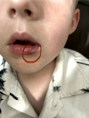 To have no idea what to do about cold sore?