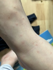 Does this look like chicken pox?
