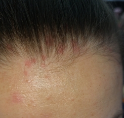 PLEASE HELP! Painful mystery rash on head!