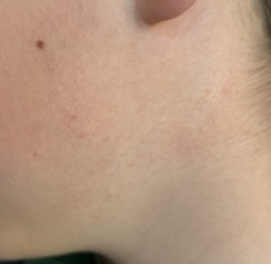 Rash on DS