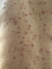 What will help my husbands skin?