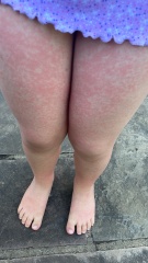 What could this rash be??pictures