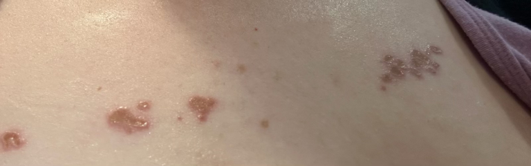 Rash?