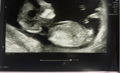 ADVICE PLEASE - Abnormal Nuchal Translucency