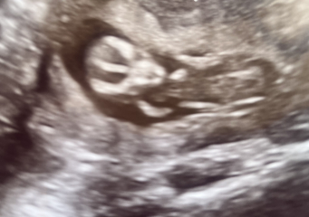 Gender guesses ? scan photo 13 weeks !