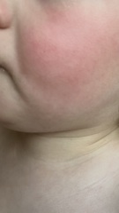 Slapped cheek or allergy?