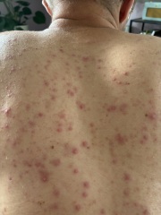 What will help my husbands skin?