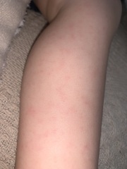 Rash on toddler’s legs
