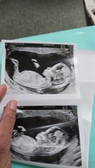 boy or girl