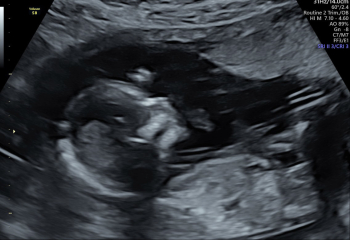BFP after IVF - the journey continues (part 2)
