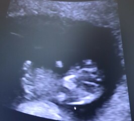 Nub at 9,5 weeks?