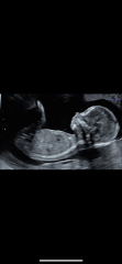Gender scan - definitely a boy?