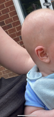 Flat head in my 4 month old. Is this severe??