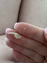 Discharge- 24 weeks (TMI PHOTO WARNING)