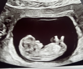 Scan picture, lump on head.