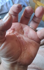 Methotrexate - Psoriasis