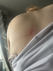 Eczema!? Shingles?!