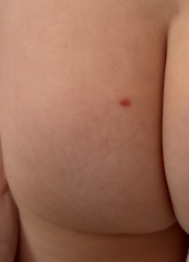 New red mole/spot