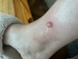 what is this that has appeared on my leg ?