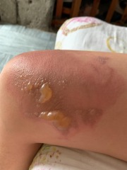 Will this 2nd degree burn leave a scar?