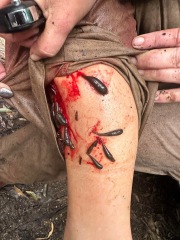 Attacked by Leeches- TMI Photos