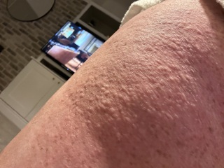 Any ideas on rash? Driving me mad!