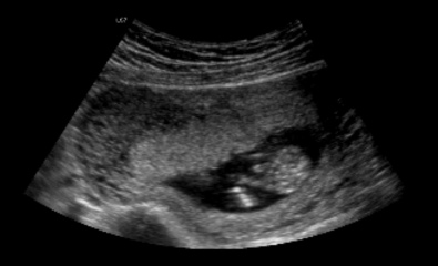Gender scan told boy
