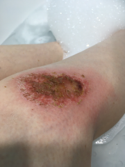 Does this graze look infected?