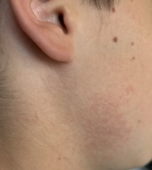 Rash on DS