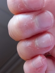 Peeling skin on fingertips - any ideas? Definitely NOT because I don't moisturise ;-)