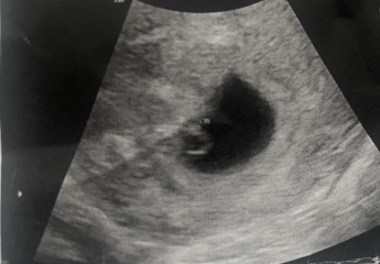 Ramzi theory scan photo