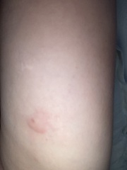 Weird lump suddenly appeared on arm by implant