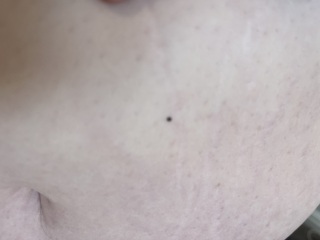 New black mark on skin