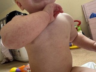 Mild Hand Foot & Mouth 9 Month Old