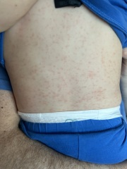 12 month old has a rash