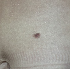 This is a dodgy mole isn't it