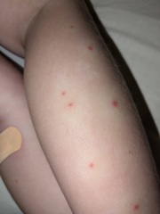 Infected bits getting worse?