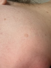 Pregnancy skin