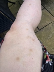 Bruising