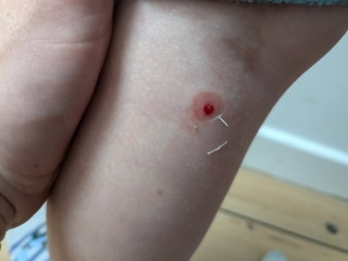 Infected bits getting worse?